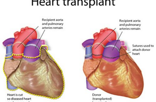 CARDIAC (HEART) TRANSPLANTATION 4